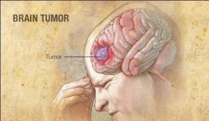 a-medical-illustration-of-a-brain-tumor-original-e1573220396572_9f5154651a7e43dc9c83daa02b169ad7_grande