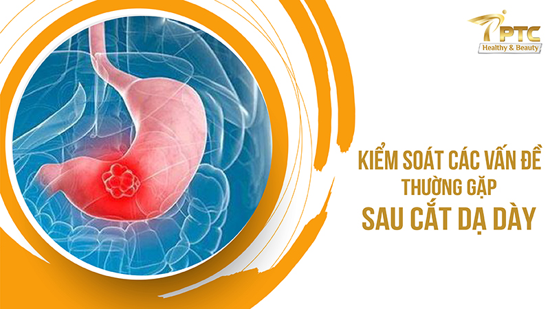 kiểm soát các yếu tố thường gặp sau cắt dạ dày 