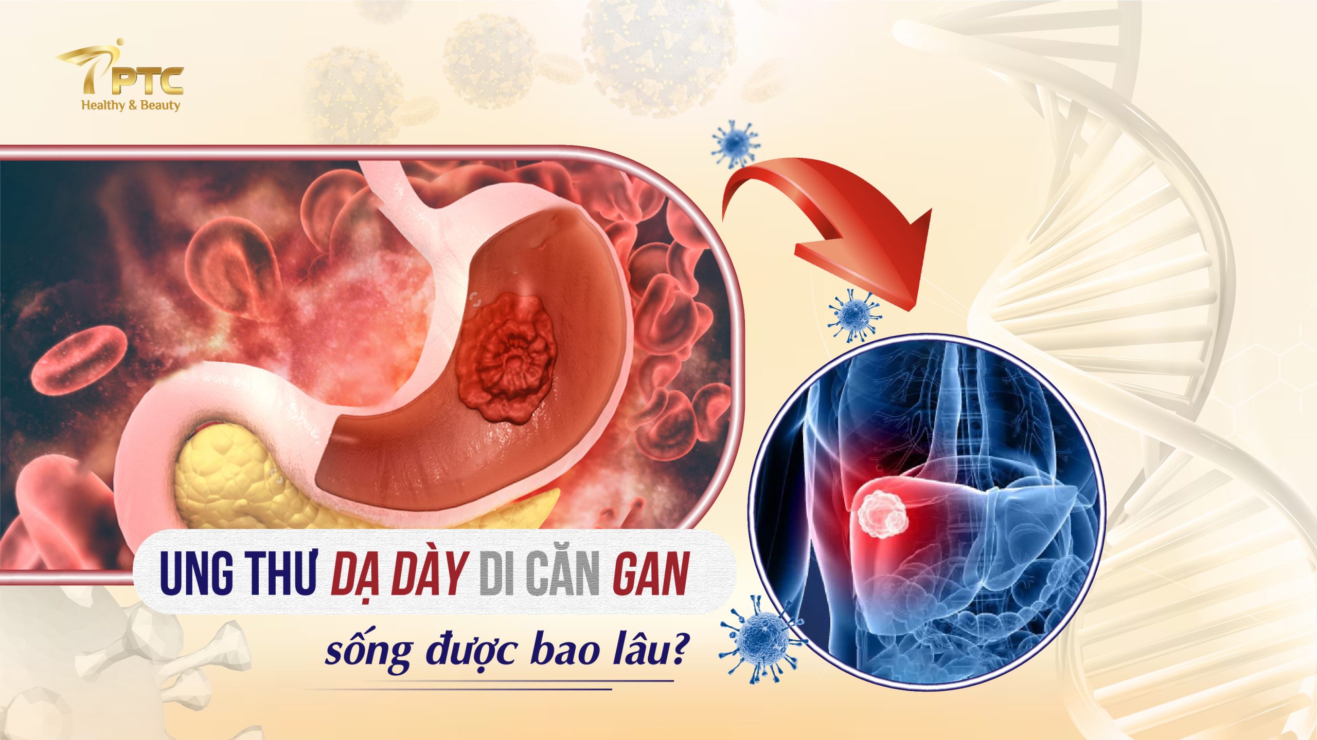 Ung thư dạ dày di căn gan sống được bao lâu?