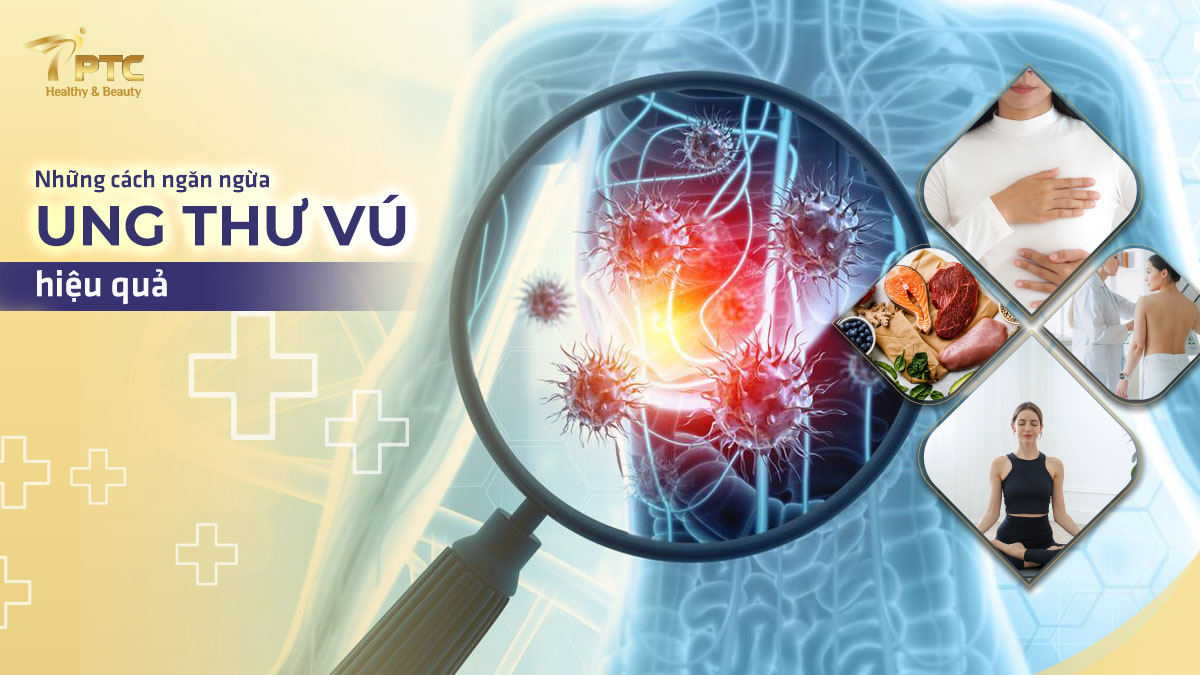 Các cách ngăn ngừa ung thư vú ngay từ khi chưa có triệu chứng