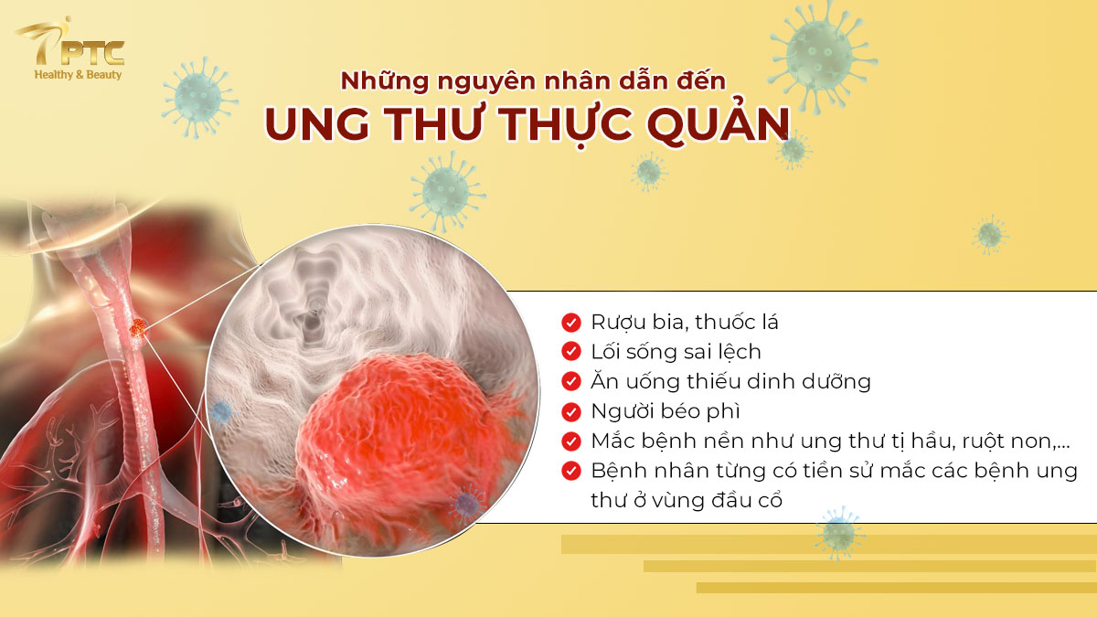 NGUYÊN NHÂN DẪN ĐẾN UNG THƯ THỰC QUẢN