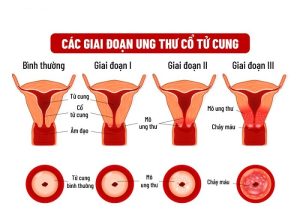 nguyen-nhan-ung-thu-co-tu-cung