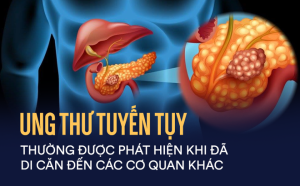 ung-thu-tuyen-tuy