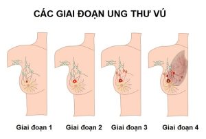 ung-thu-vu